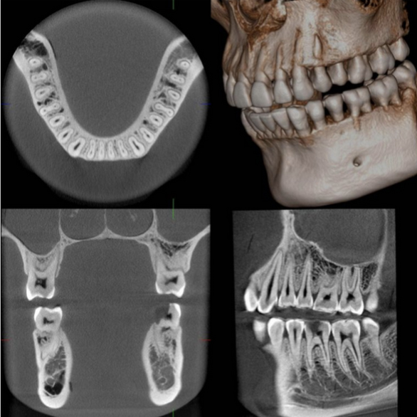 TAC FOV-16X18 y radiografía ultima generación